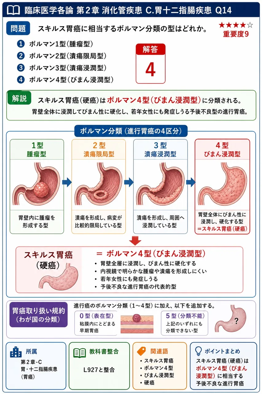 スキルス胃癌に相当するボルマン分類の型はどれか。 解説図