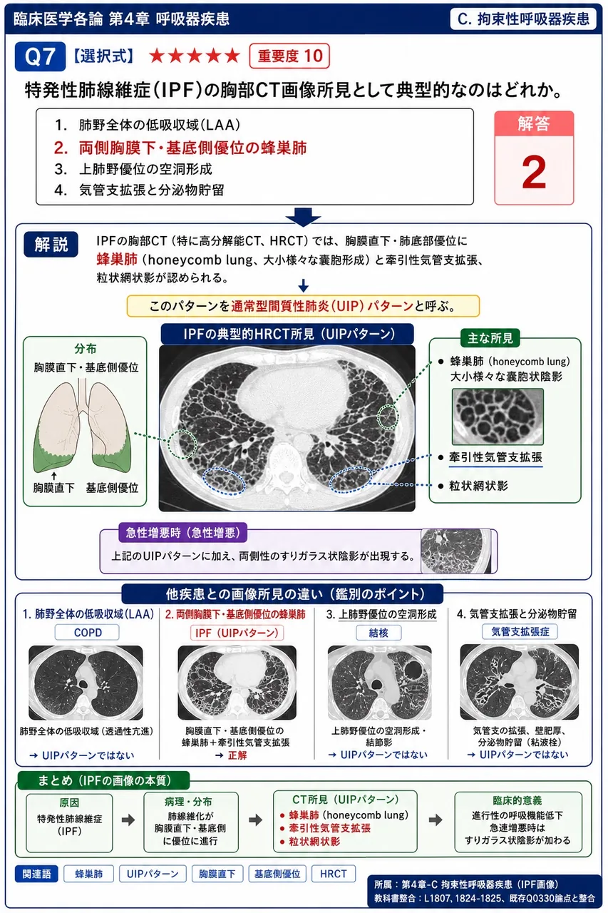 特発性肺線維症(IPF)の胸部CT画像所見として典型的なのはどれか。 解説図