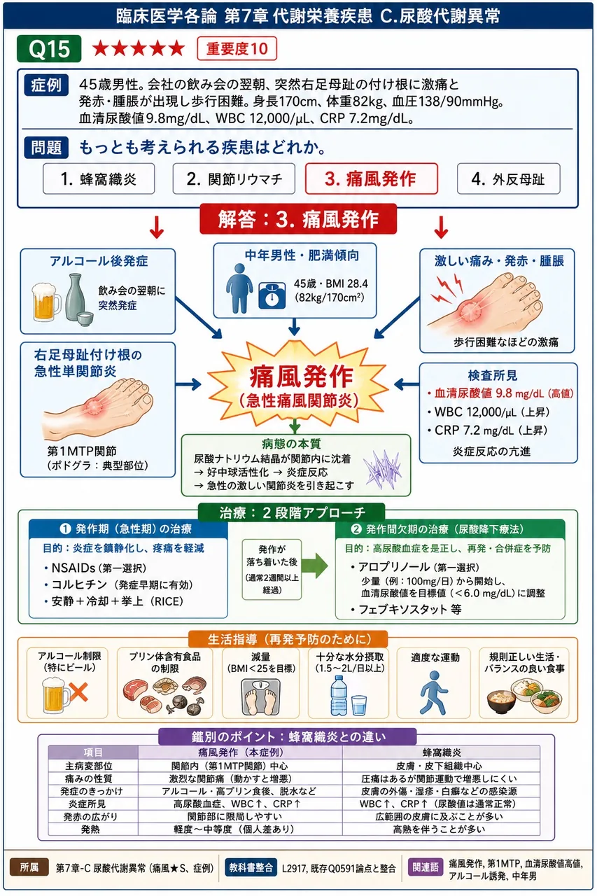 45歳男性。会社の飲み会の翌朝、突然右足母趾の付け根に激痛と発赤・腫脹が出現し歩行困難。身長170cm、体重82kg、血圧138/90mmHg。血清尿酸値9.8mg/dL、WBC 12,000/μL、CRP 7.2mg/dL。もっとも考えられる疾患はどれか。 解説図