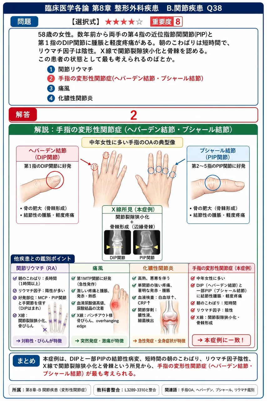 「58歳の女性。数年前から両手の第4指の近位指節間関節(PIP)と第1指のDIP関節に腫脹と軽度疼痛がある。朝のこわばりは短時間で、リウマチ因子は陰性。X線で関節裂隙狭小化と骨棘を認める。」この患者の状態として最も考えられるのはどれか。 解説図