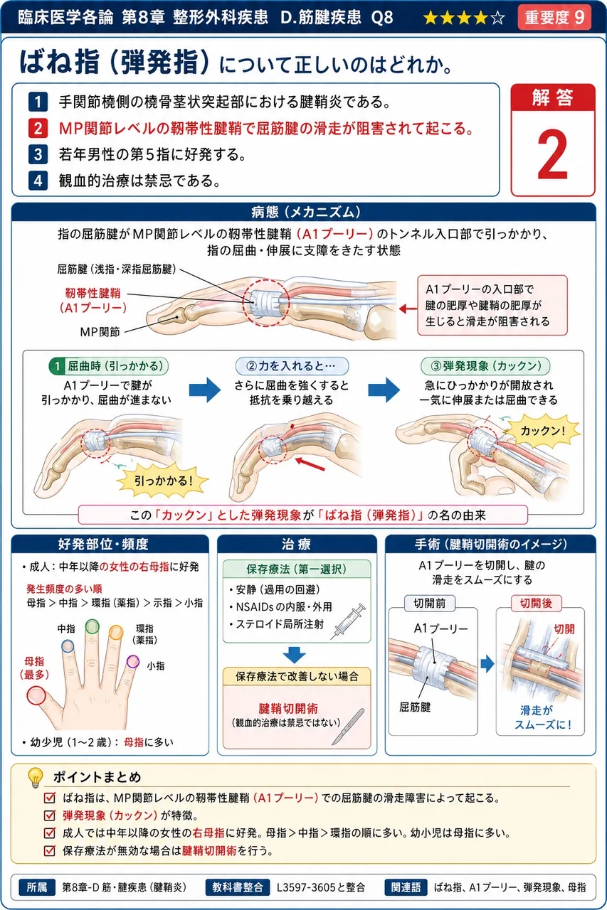 ばね指(弾発指)について正しいのはどれか。 解説図