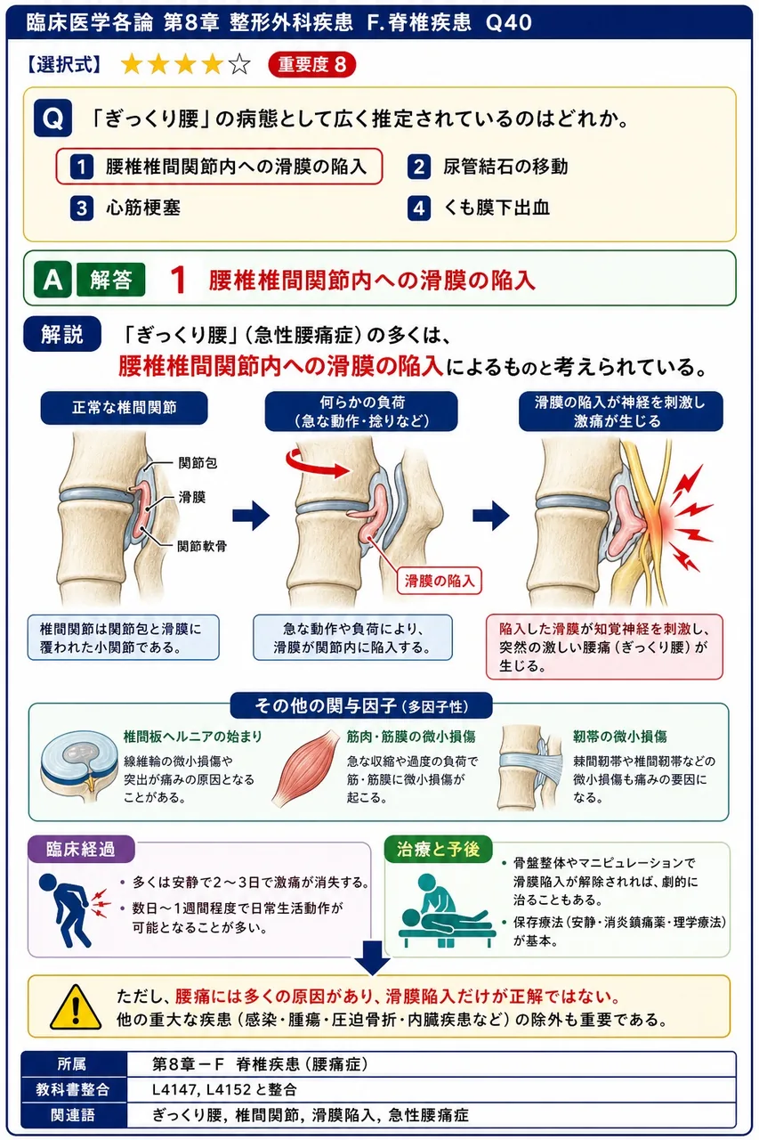 「ぎっくり腰」の病態として広く推定されているのはどれか。 解説図
