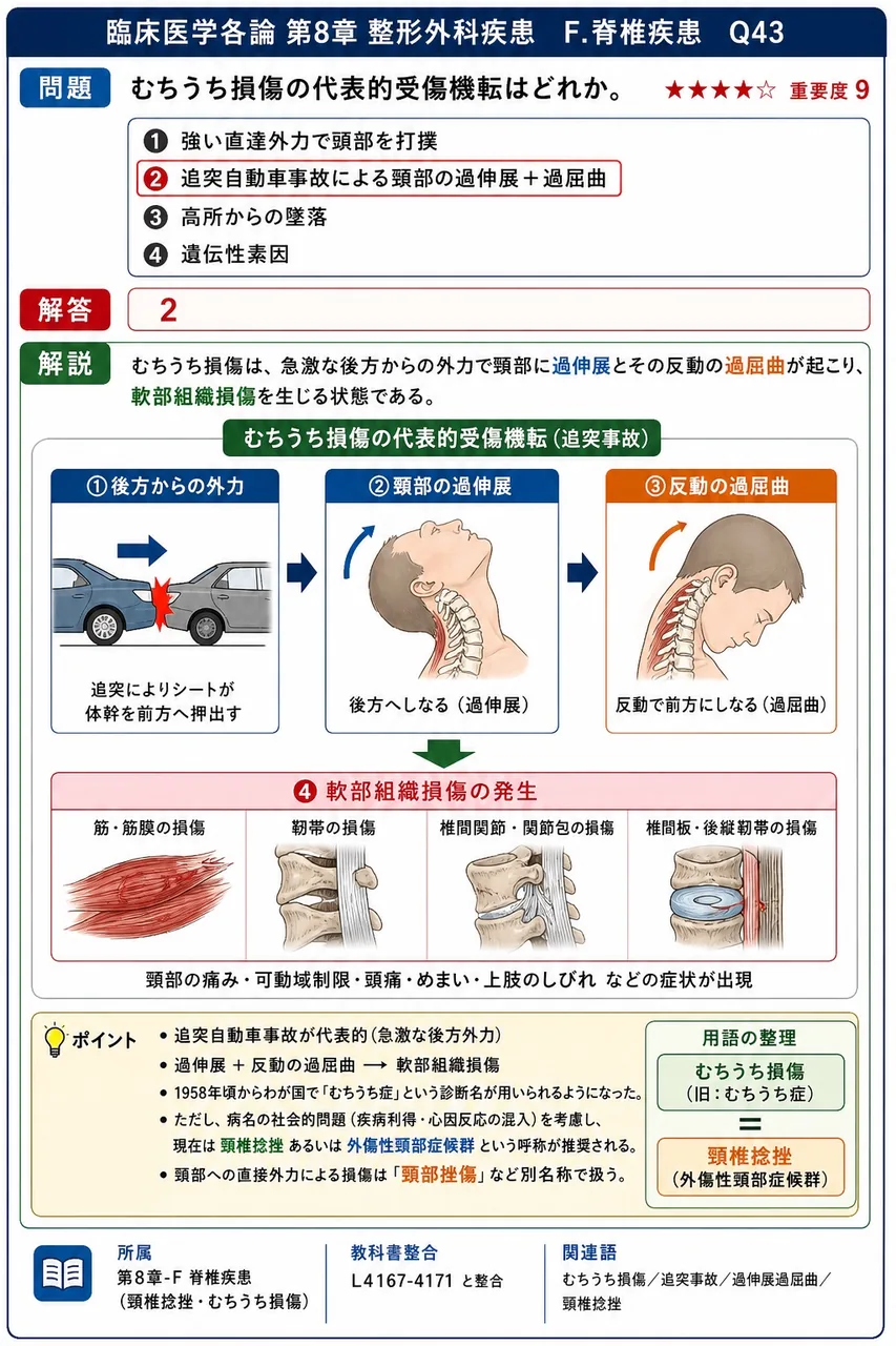 むちうち損傷の代表的受傷機転はどれか。 解説図