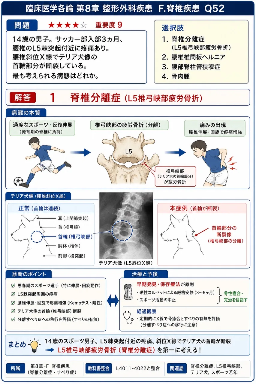 「14歳の男子。サッカー部入部3ヵ月、腰椎のL5棘突起付近に疼痛あり。腰椎斜位X線でテリア犬像の首輪部分が断裂している。」最も考えられる病態はどれか。 解説図
