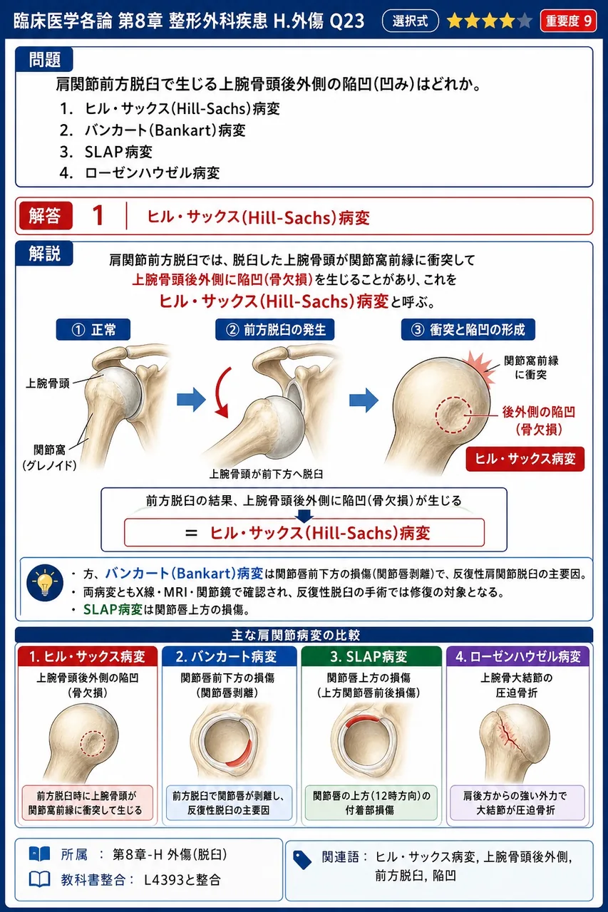 肩関節前方脱臼で生じる上腕骨頭後外側の陥凹(凹み)はどれか。 解説図