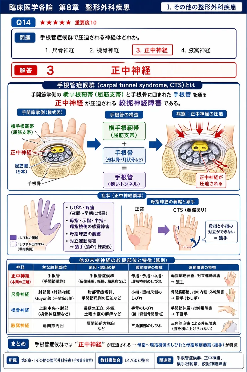手根管症候群で圧迫される神経はどれか。 解説図