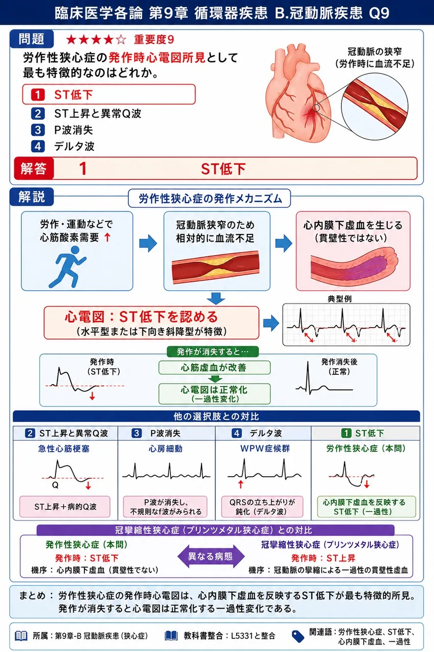 労作性狭心症の発作時心電図所見として最も特徴的なのはどれか。 解説図