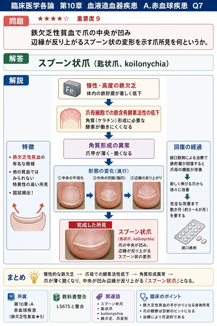 鉄欠乏性貧血で爪の中央が凹み辺縁が反り上がるスプーン状の変形を示す爪所見を何というか。 解説図
