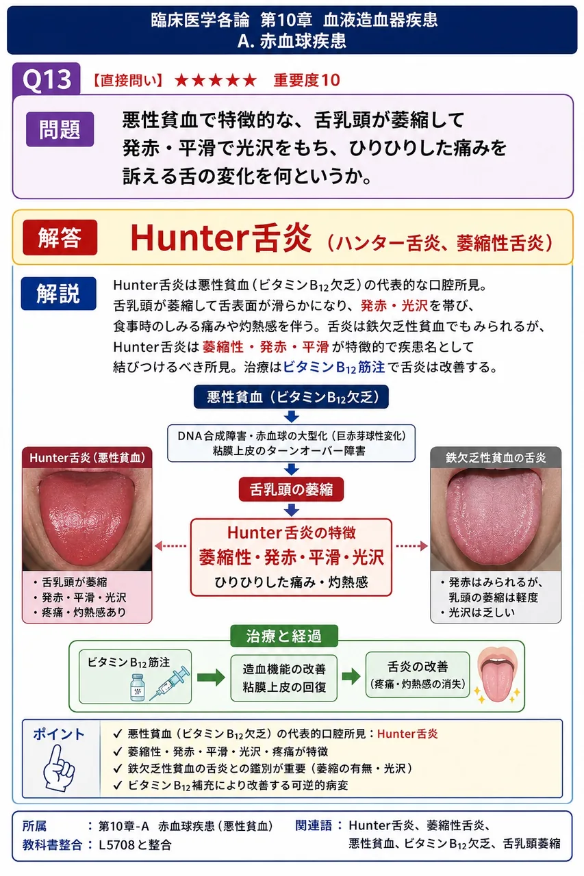 悪性貧血で特徴的な、舌乳頭が萎縮して発赤・平滑で光沢をもち、ひりひりした痛みを訴える舌の変化を何というか。 解説図