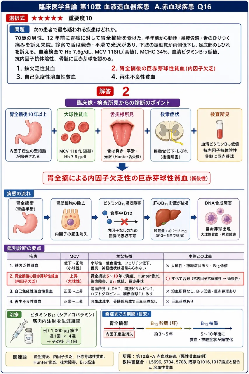 次の患者で最も疑われる疾患はどれか。 「70歳の男性。12年前に胃癌に対して胃全摘術を受けた。半年前から動悸・易疲労感・舌のひりつく痛みを訴え来院。診察で舌は発赤・平滑で光沢があり、下肢の振動覚が両側低下し、足底部のしびれを訴える。血液検査でHb 7.6g/dL、MCV 118fL(高値)、MCHC 34%、血清ビタミンB12低値、抗内因子抗体陰性、骨髄に巨赤芽球を認める。」 解説図