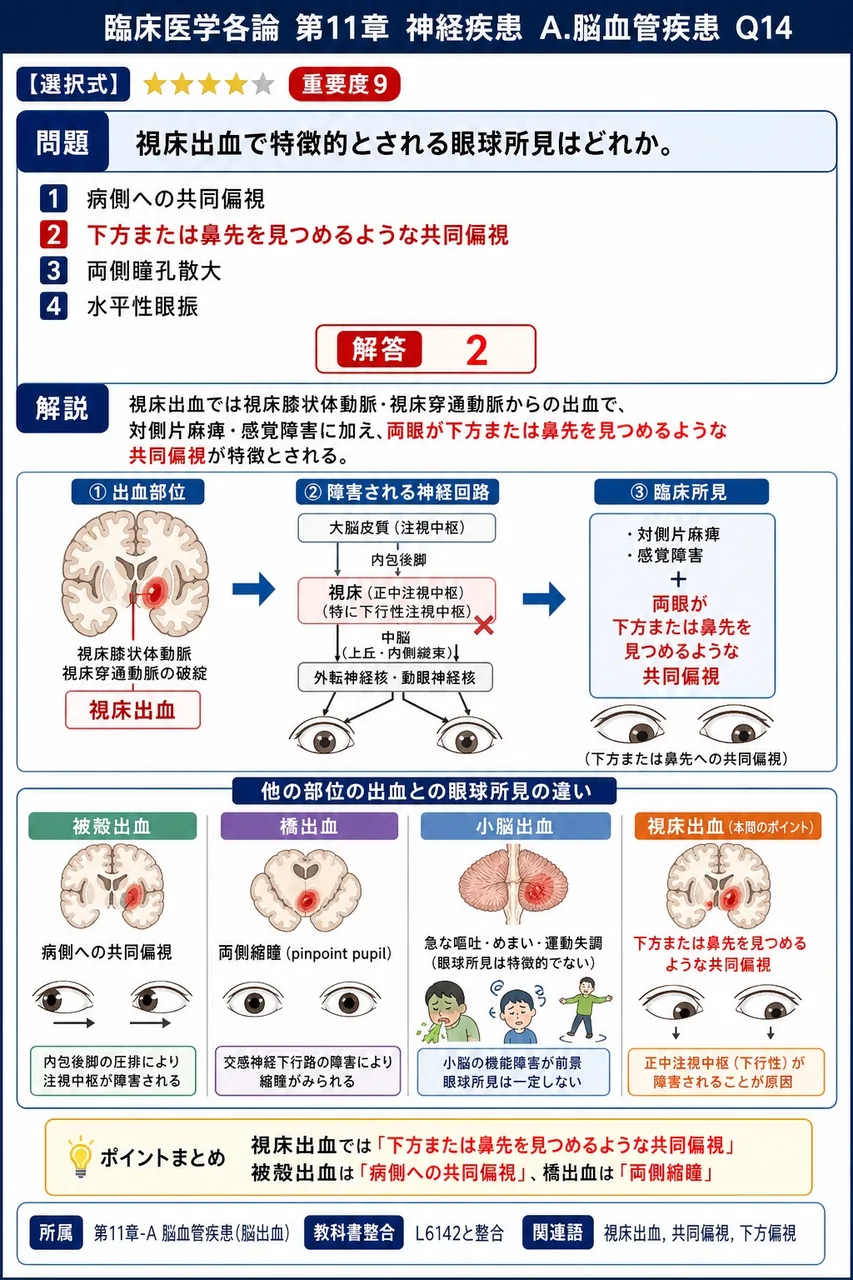 視床出血で特徴的とされる眼球所見はどれか。 解説図