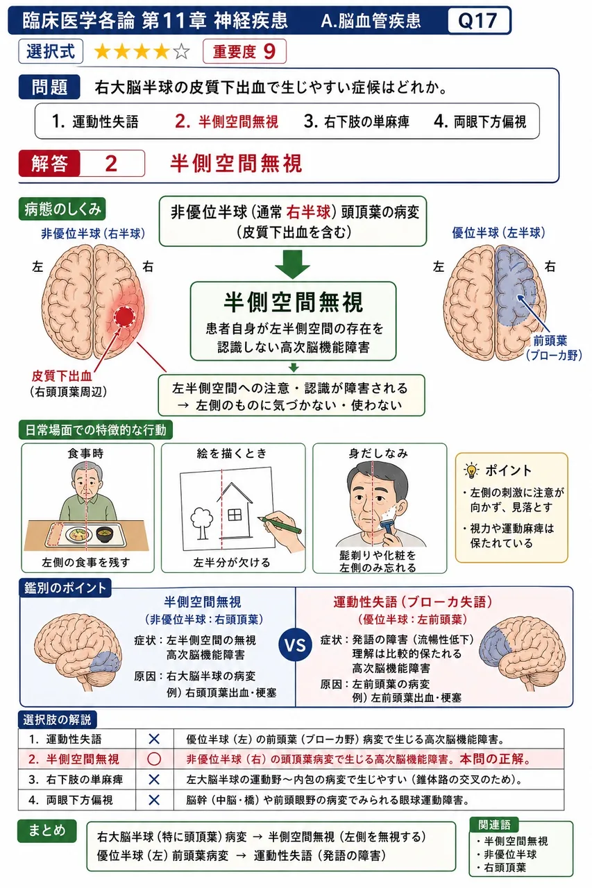 右大脳半球の皮質下出血で生じやすい症候はどれか。 解説図
