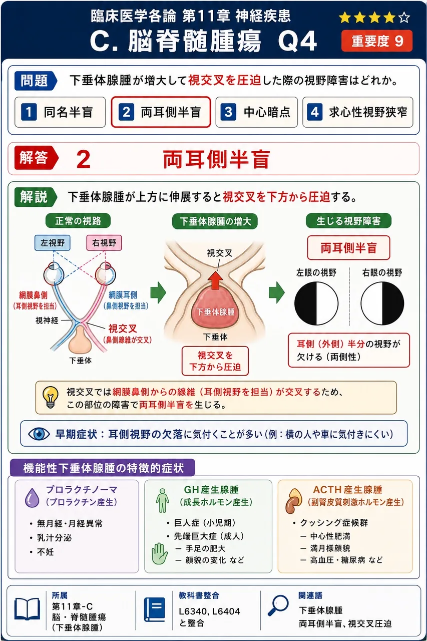 下垂体腺腫が増大して視交叉を圧迫した際の視野障害はどれか。 解説図