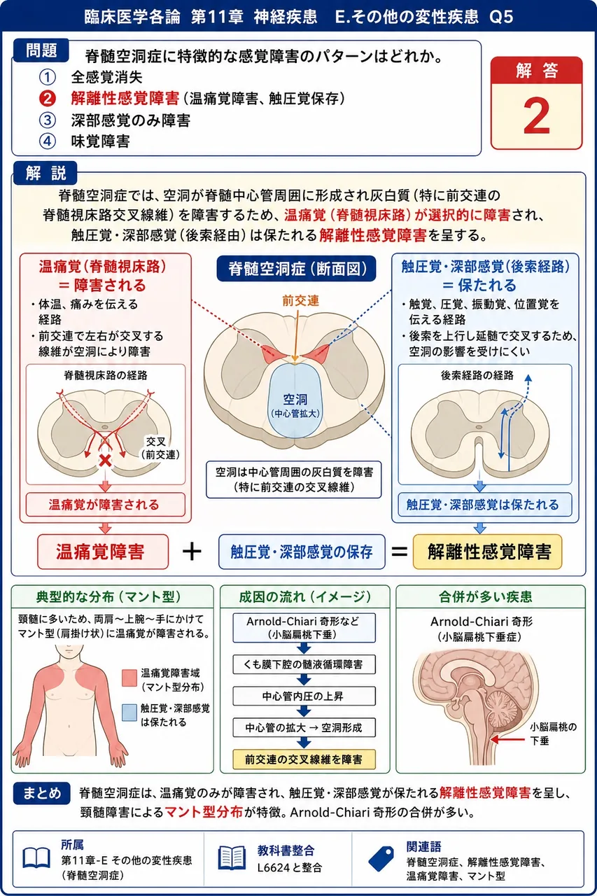 脊髄空洞症に特徴的な感覚障害のパターンはどれか。 解説図