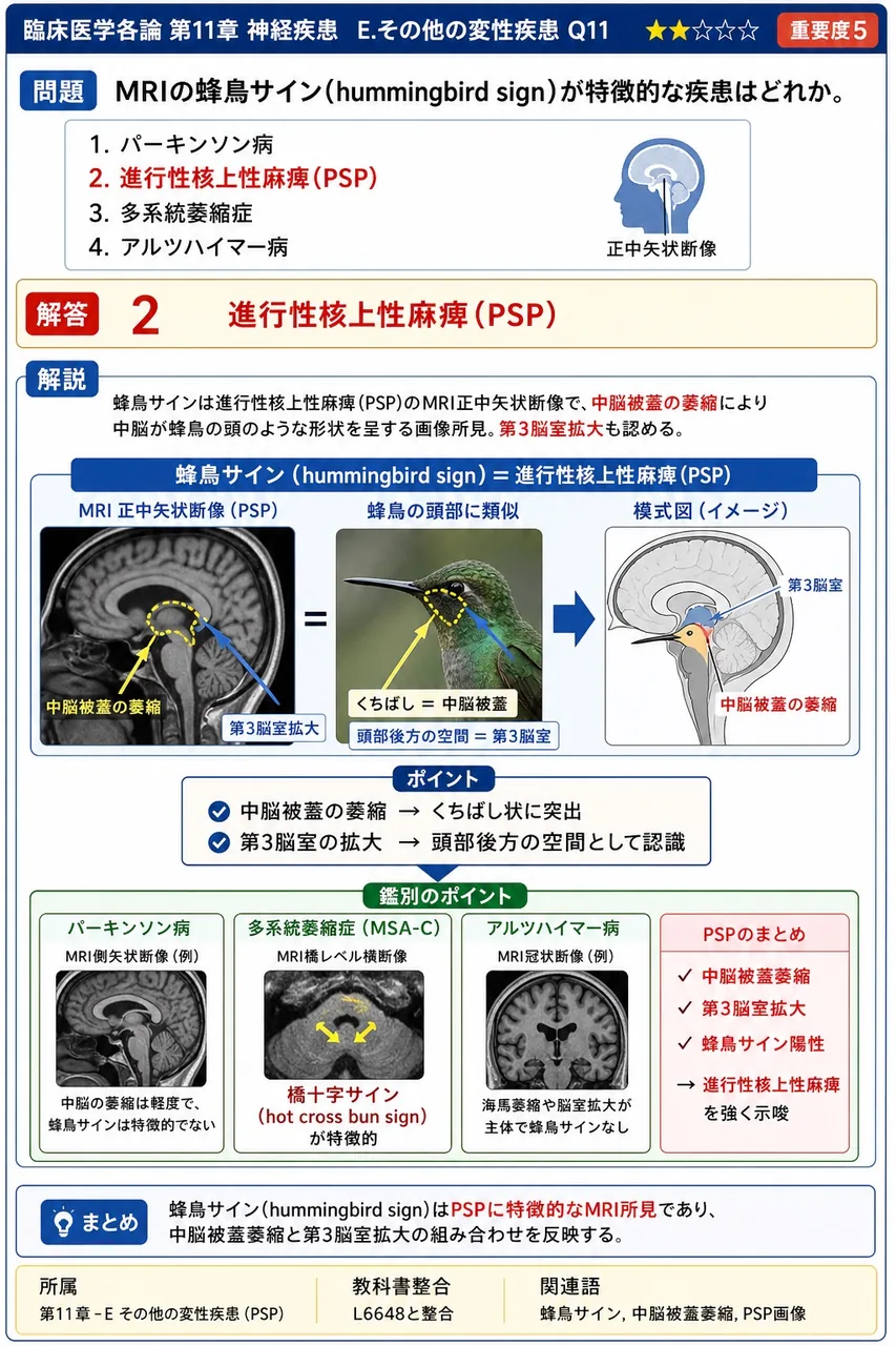 MRIの蜂鳥サイン(hummingbird sign)が特徴的な疾患はどれか。 解説図