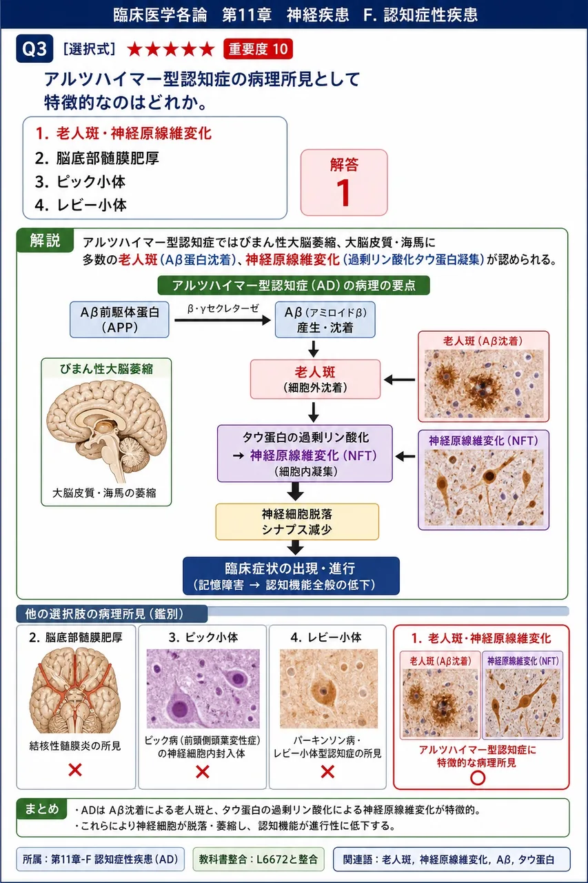 アルツハイマー型認知症の病理所見として特徴的なのはどれか。 解説図