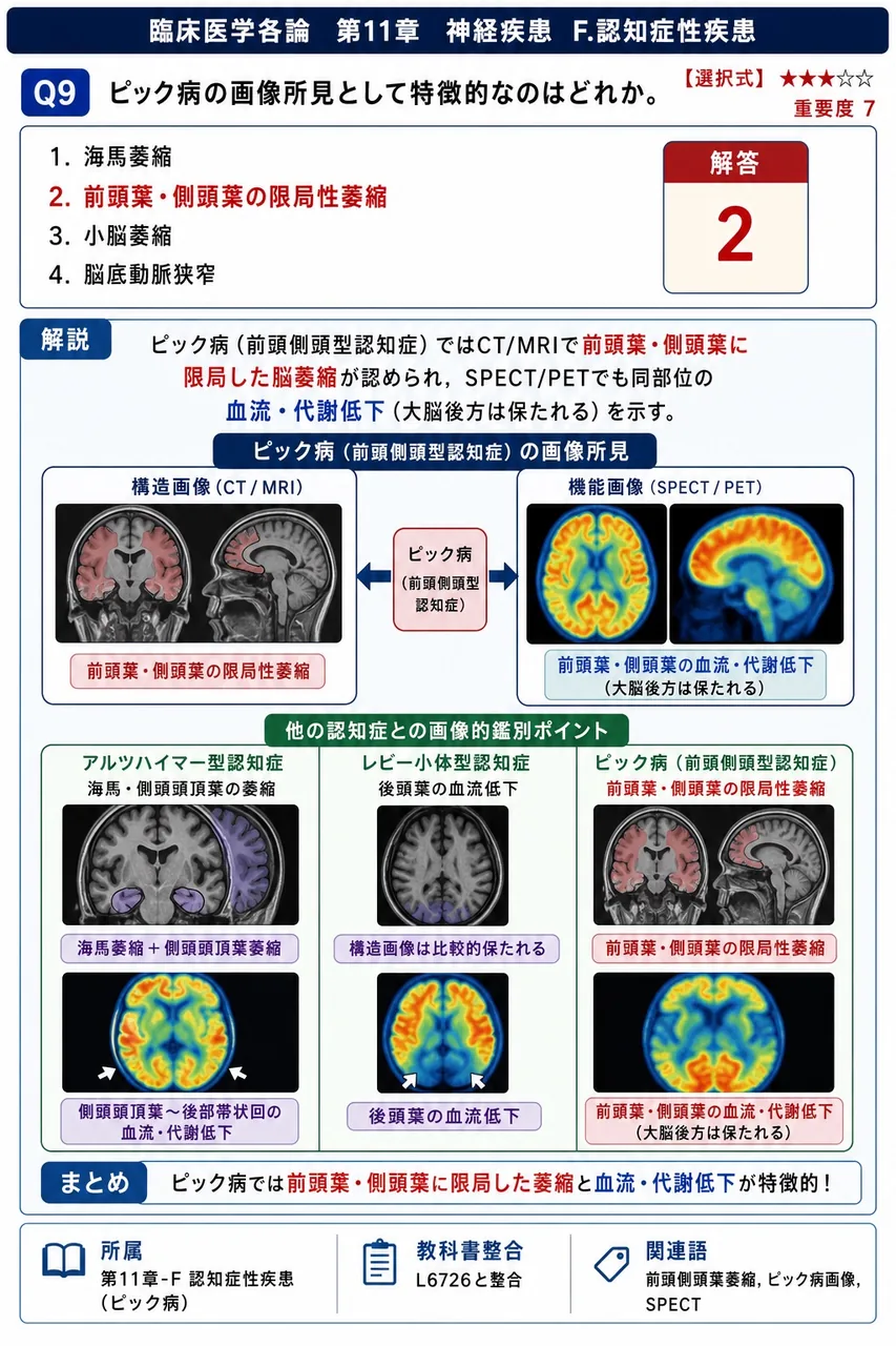 ピック病の画像所見として特徴的なのはどれか。 解説図