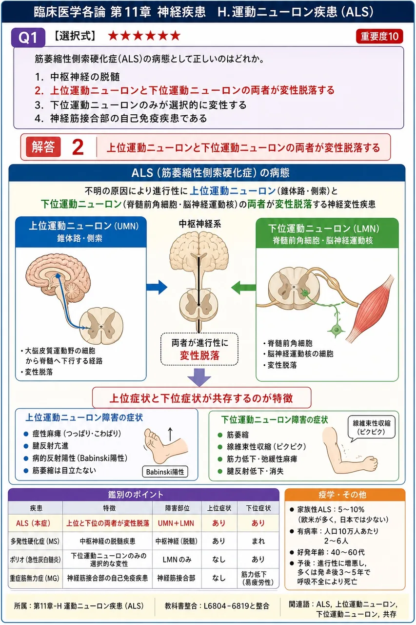 筋萎縮性側索硬化症(ALS)の病態として正しいのはどれか。 解説図