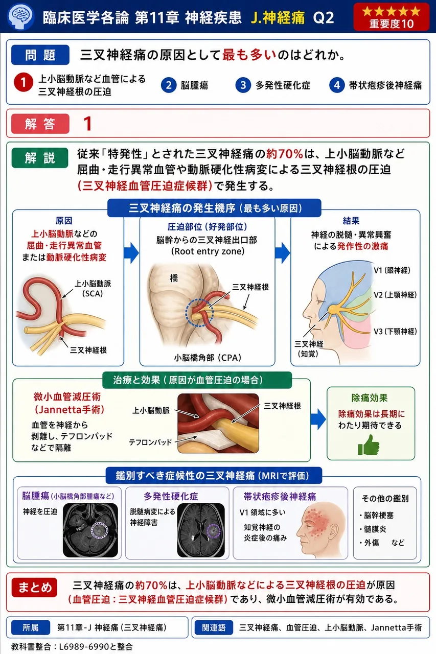 三叉神経痛の原因として最も多いのはどれか。 解説図