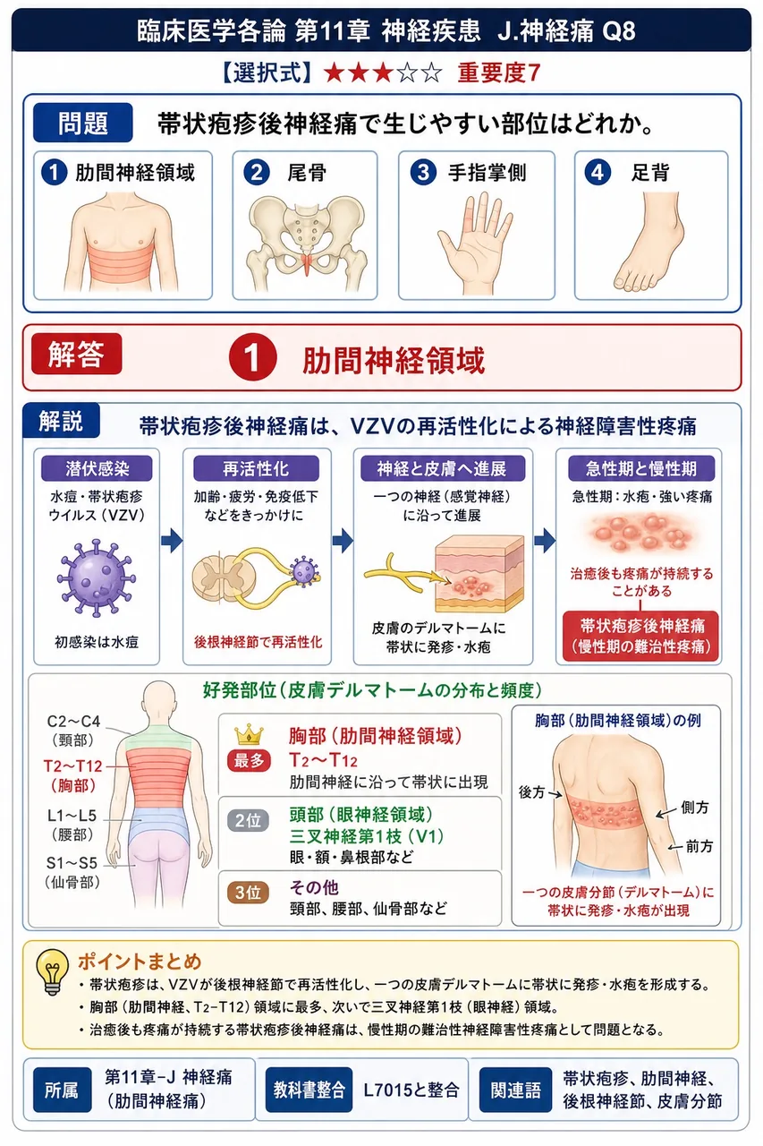 帯状疱疹後神経痛で生じやすい部位はどれか。 解説図