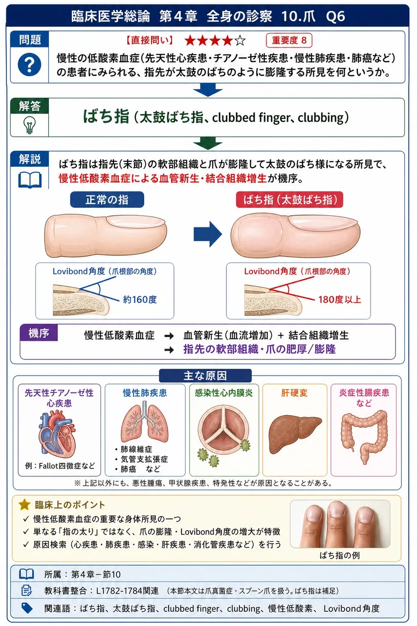 慢性の低酸素血症(先天性心疾患・チアノーゼ性疾患・慢性肺疾患・肺癌など)の患者にみられる、指先が太鼓のばちのように膨隆する所見を何というか。 解説図