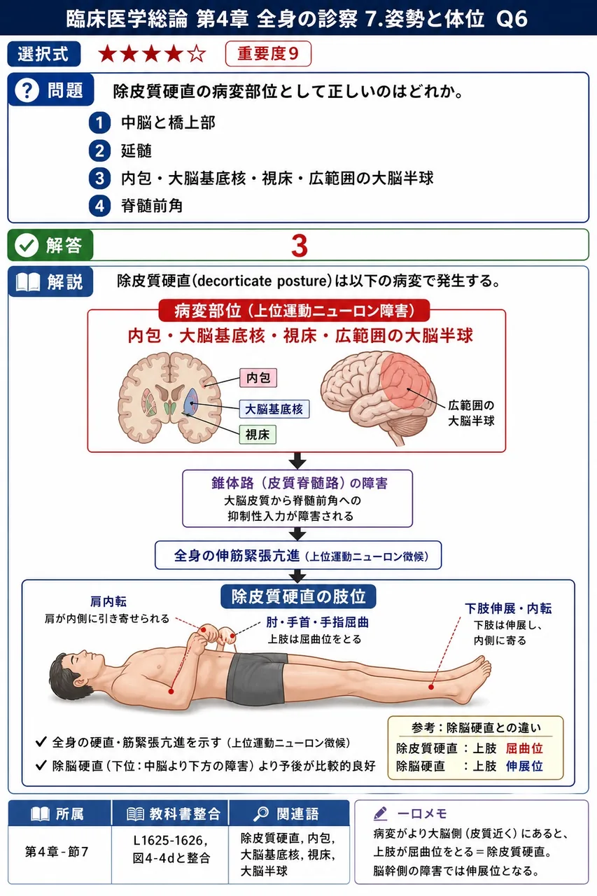 除皮質硬直の病変部位として正しいのはどれか。 解説図