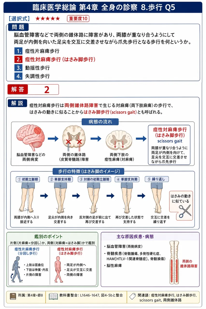 脳血管障害などで両側の錐体路に障害があり、両膝が重なり合うようにして両足が内側を向いた足尖を交互に交差させながら爪先歩行となる歩行を何というか。 解説図