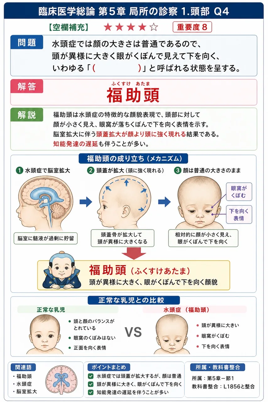 水頭症では顔の大きさは普通であるので、頭が異様に大きく眼がくぼんで見えて下を向く、いわゆる「( )」と呼ばれる状態を呈する。 解説図