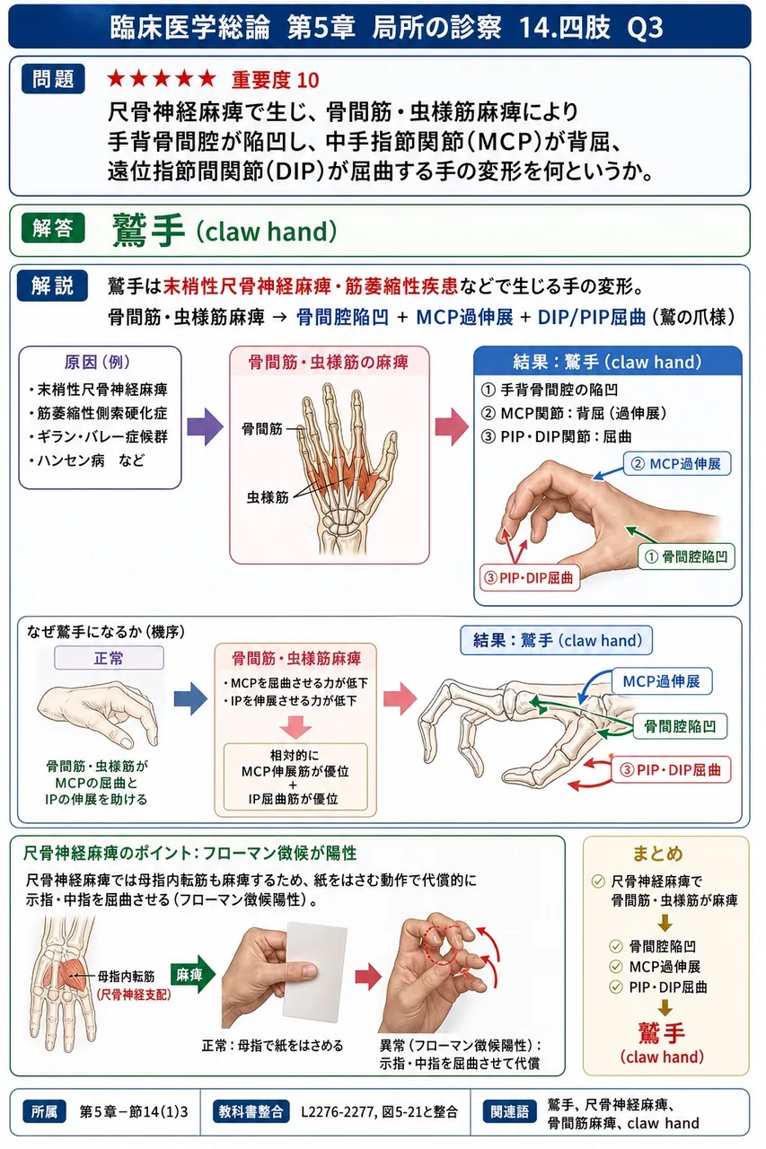 尺骨神経麻痺で生じ、骨間筋・虫様筋麻痺により手背骨間腔が陥凹し、中手指節関節(MCP)が背屈、遠位指節間関節(DIP)が屈曲する手の変形を何というか。 解説図