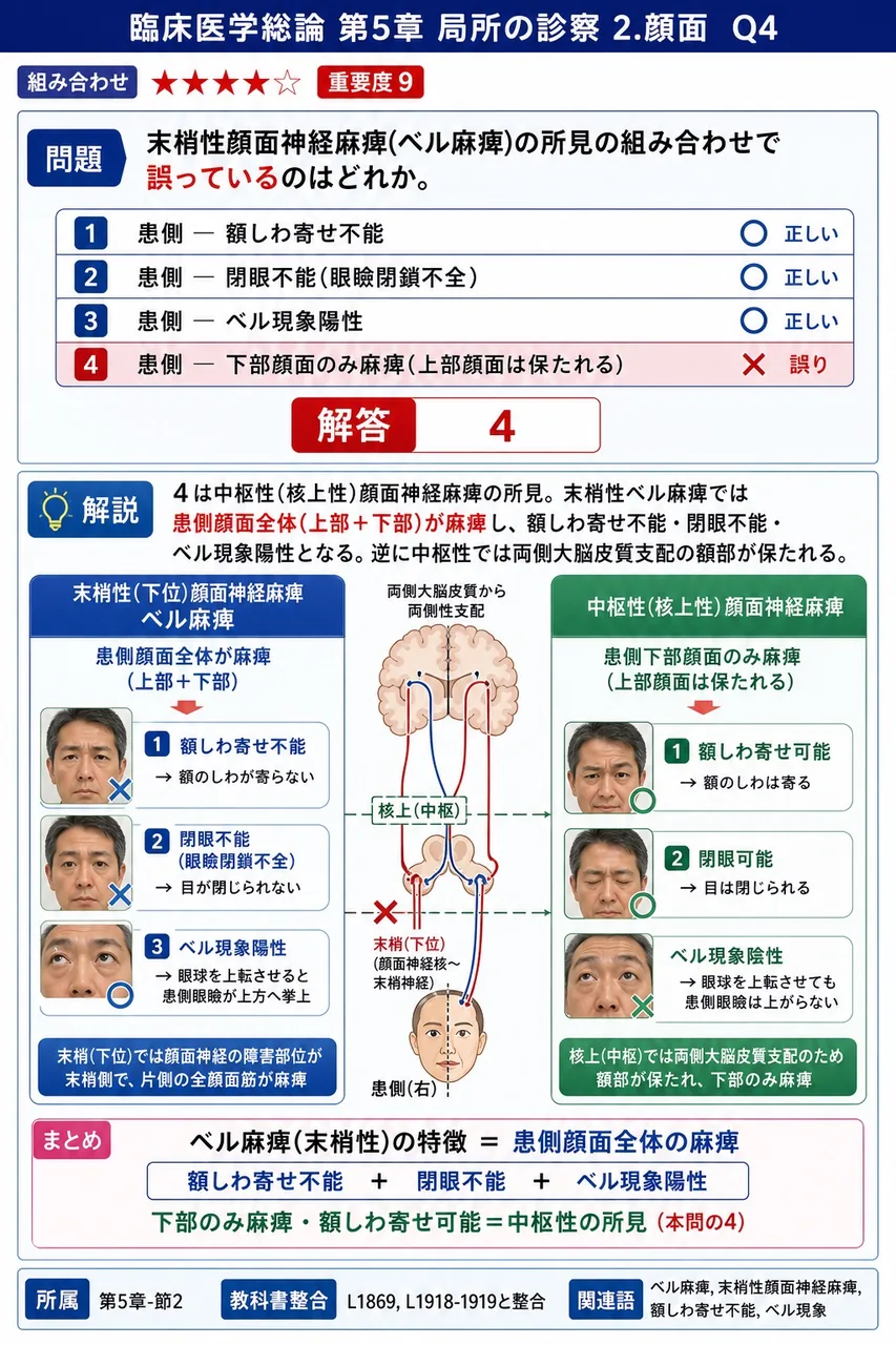 末梢性顔面神経麻痺(ベル麻痺)の所見の組み合わせで誤っているのはどれか。 解説図