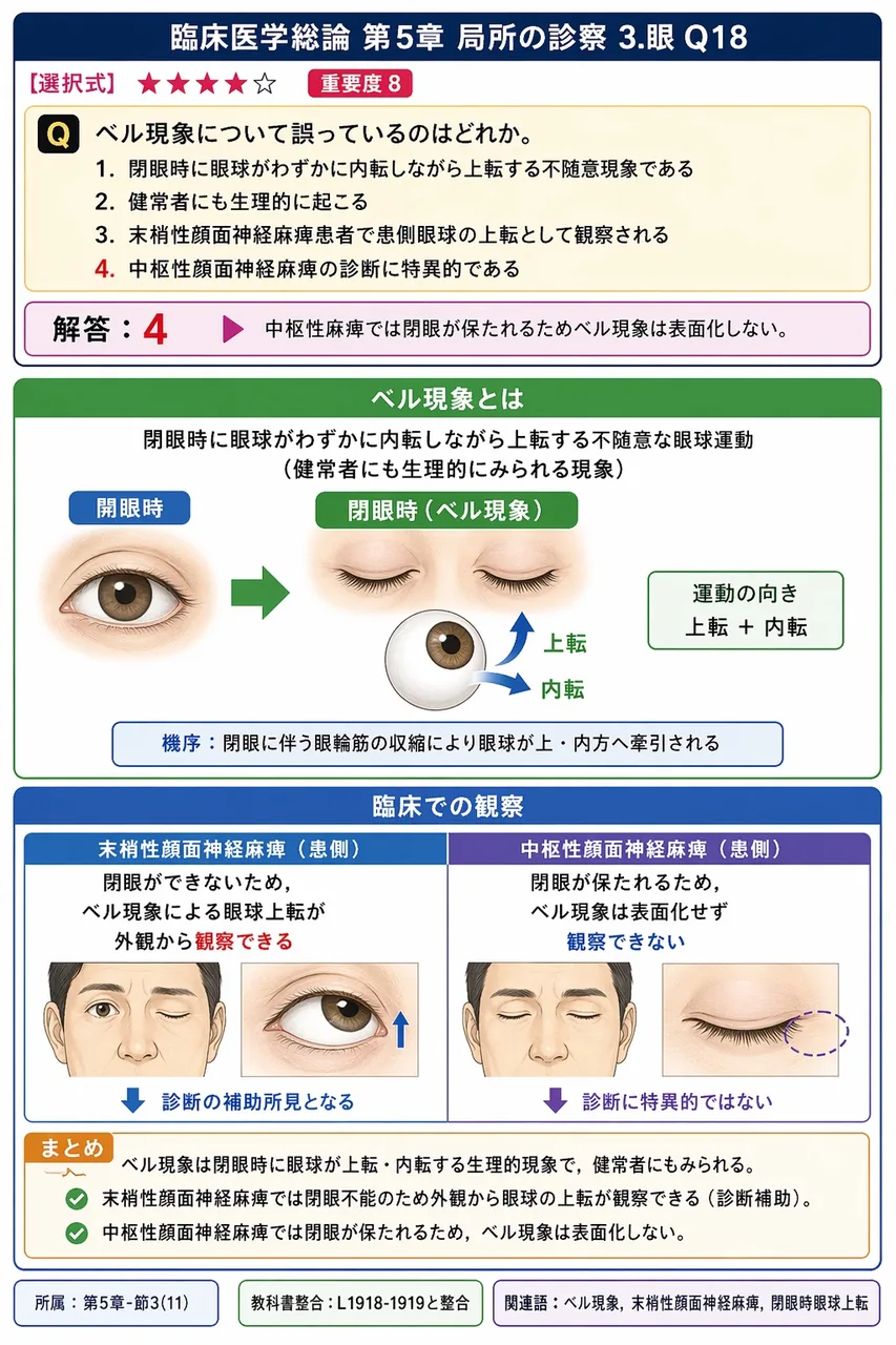 ベル現象について誤っているのはどれか。 解説図