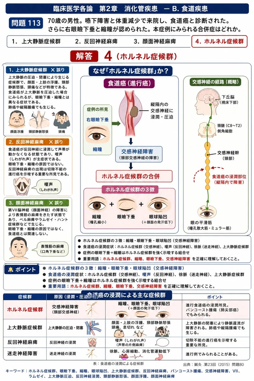鍼灸 第23回(2015) 問題80｜「70歳の男性。嚥下障害と体重減少で来院し、食道癌と診断された。さらに右眼瞼下垂と縮瞳が認められた。」本症例にみられる合併症はどれか。 解説図