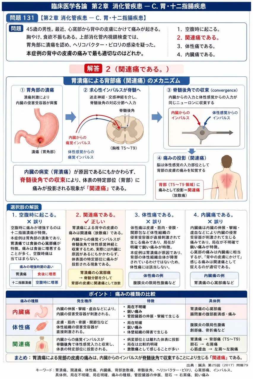 鍼灸 第25回(2017) 問題79|「45歳の男性。最近、心窩部から背中の皮膚にかけて痛みが起きる。胸やけ、食欲不振もある。上部消化管内視鏡検査では、胃角部に潰瘍を認め、ヘリコバクター・ピロリの感染を疑った。」本症例の背中の皮膚の痛みで最も適切なのはどれか。 解説図