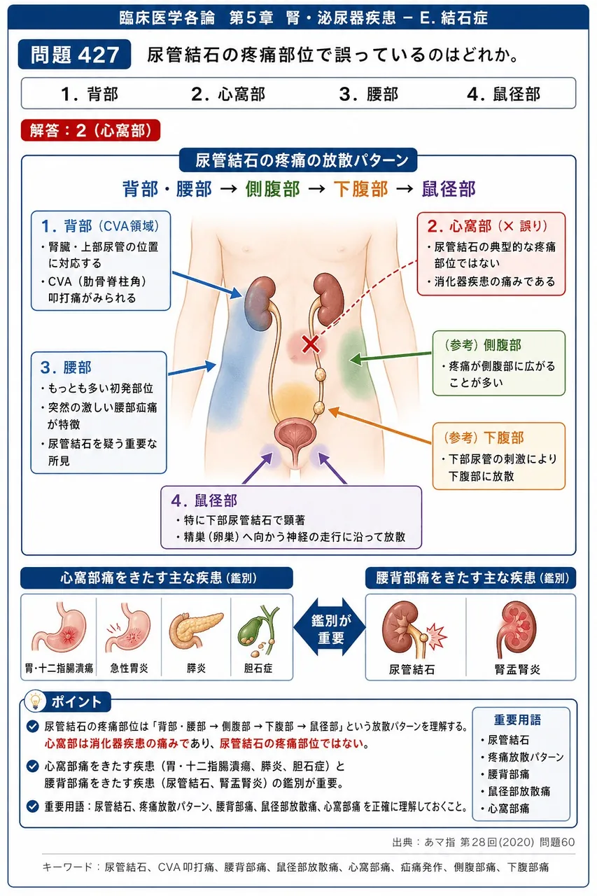 あマ指 第28回(2020) 問題60｜尿管結石の疼痛部位で誤っているのはどれか。 解説図