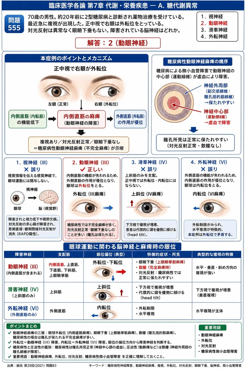 鍼灸 第29回(2021) 問題83|「70歳の男性。約20年前に2型糖尿病と診断され薬物治療を受けている。最近急に複視が出現した。正中視で右眼は外転位をとっている。対光反射は異常なく眼瞼下垂もない。」障害されている脳神経はどれか。 解説図