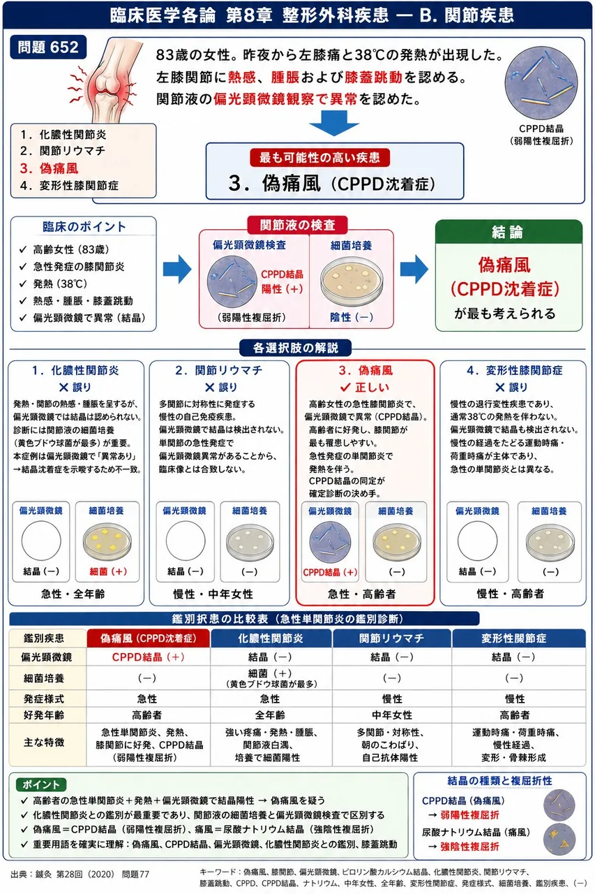 鍼灸 第28回(2020) 問題77|「83歳の女性。昨夜から左膝痛と38℃の発熱が出現した。左膝関節に熱感、腫脹および膝蓋跳動を認める。関節液の偏光顕微鏡観察で異常を認めた。」最も可能性の高い疾患はどれか。 解説図