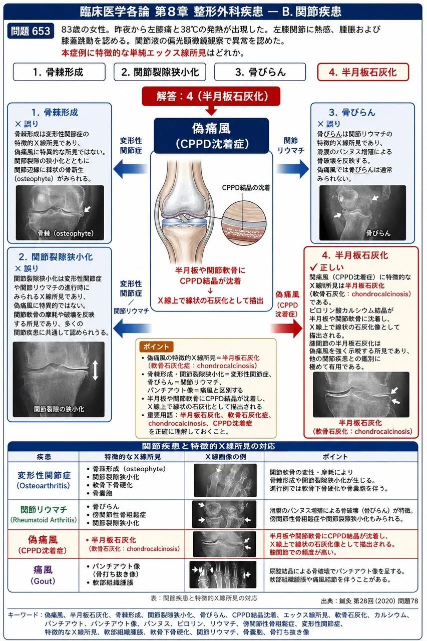鍼灸 第28回(2020) 問題78|「83歳の女性。昨夜から左膝痛と38℃の発熱が出現した。左膝関節に熱感、腫脹および膝蓋跳動を認める。関節液の偏光顕微鏡観察で異常を認めた。」本症例に特徴的な単純エックス線所見はどれか。 解説図