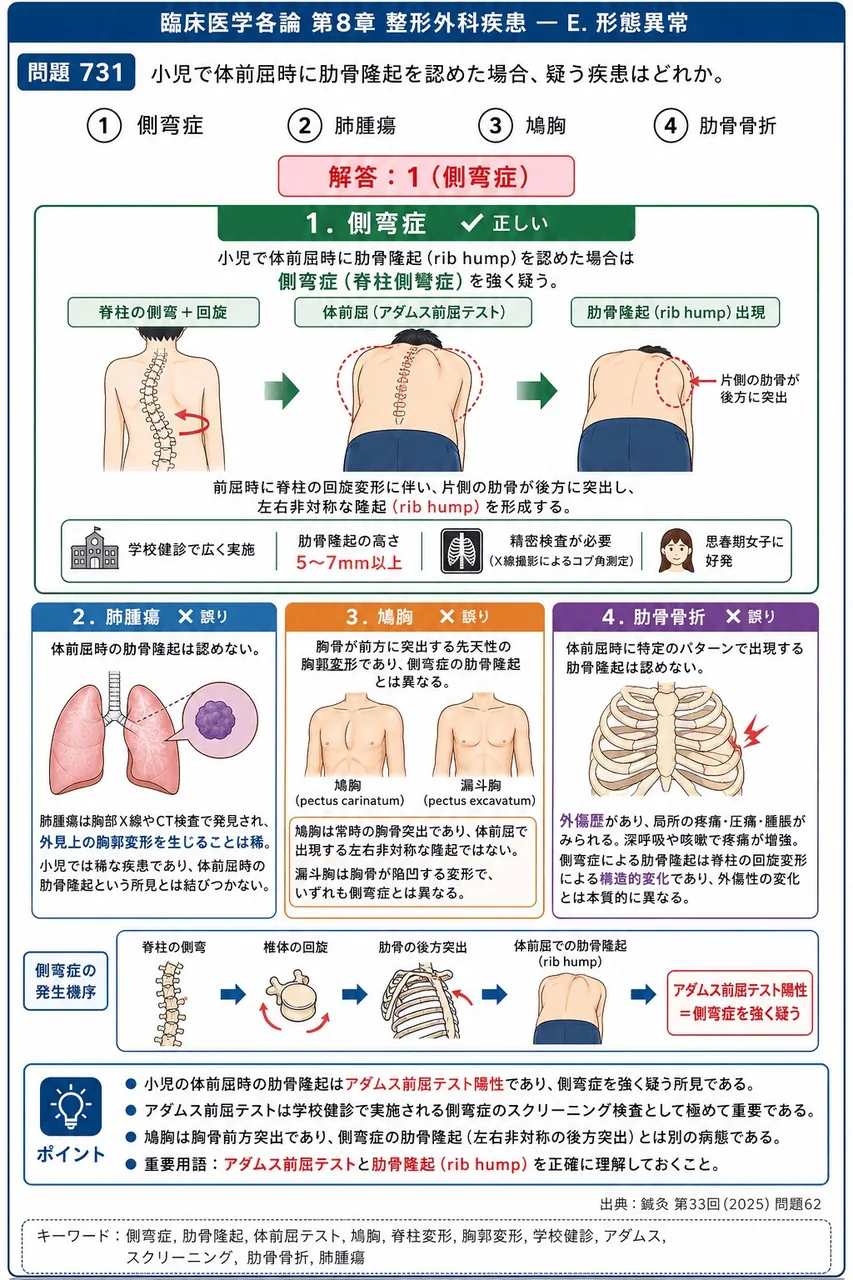 鍼灸 第33回(2025) 問題62｜小児で体前屈時に肋骨隆起を認めた場合、疑う疾患はどれか。 解説図