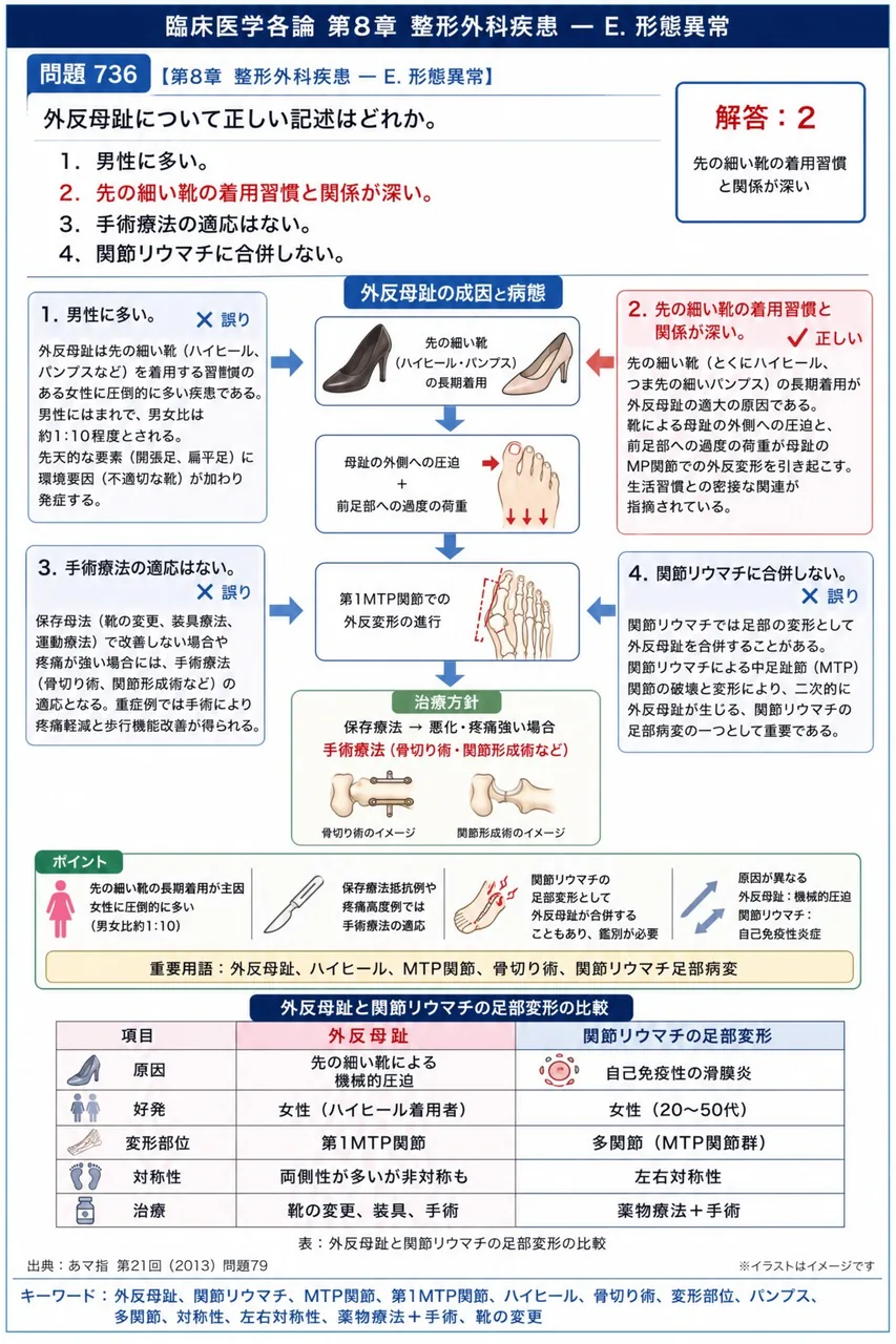 あマ指 第21回(2013) 問題79|外反母趾について正しい記述はどれか。 解説図