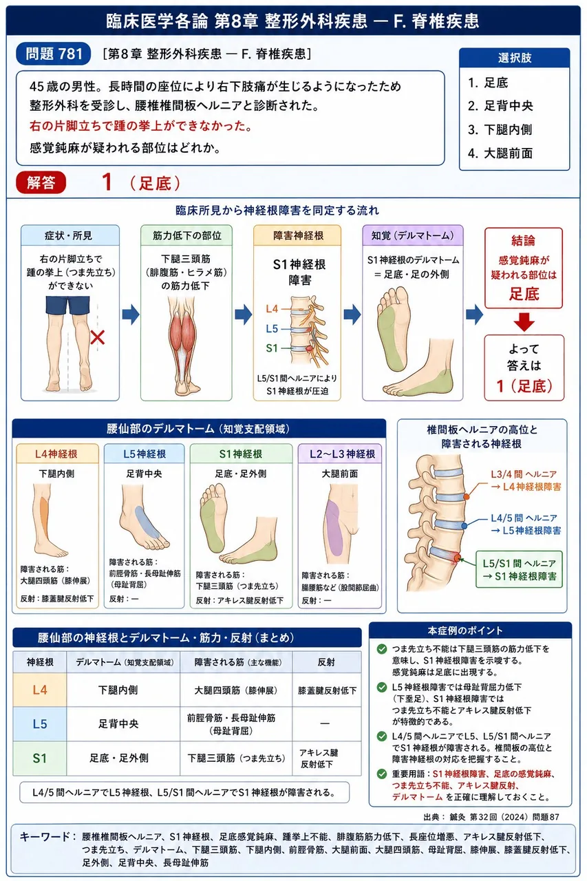鍼灸 第32回(2024) 問題87|次の文で示す症例について、問いに答えよ。「45歳の男性。長時間の座位により右下肢痛が生じるようになったため整形外科を受診し、腰椎椎間板ヘルニアと診断された。右の片脚立ちで踵の挙上ができなかった。」感覚鈍麻が疑われる部位はどれか。 解説図
