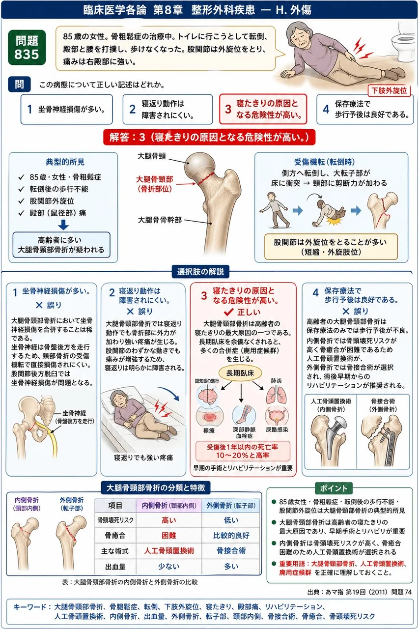 あマ指 第19回(2011) 問題74｜「85歳の女性。骨粗鬆症の治療中。トイレに行こうとして転倒、殿部と腰を打撲し、歩けなくなった。股関節は外旋位をとり、痛みは右殿部に強い。」この病態について正しい記述はどれか。 解説図