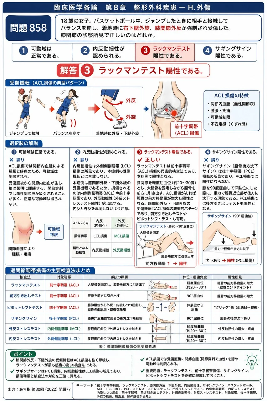 あマ指 第30回(2022) 問題77|「18歳の女子。バスケットボール中、ジャンプしたときに相手と接触してバランスを崩し、着地時に右下腿外旋、膝関節外反が強制され受傷した。」膝関節の診察所見で正しいのはどれか。 解説図