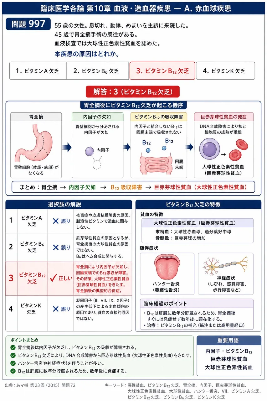 あマ指 第23回(2015) 問題72｜｢55 歳の女性。息切れ、動悸、めまいを主訴に来院した。45 歳で胃全摘手術の既往がある。血液検査では大球性正色素性貧血を認めた｡」本疾患の原因はどれか。 解説図