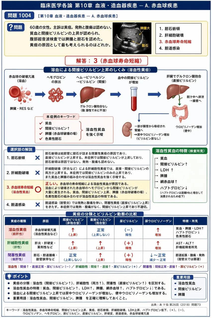 あマ指 第26回(2018) 問題73｜｢６０歳の女性。主訴は黄疸。発熱と腹痛は認めない。貧血と間接ビリルビンの上昇が認められ、腹部超音波検査では脾腫と胆石を認めた｡」黄疸の原因として最も考えられるのはどれか。 解説図