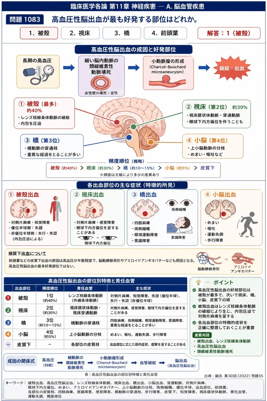 鍼灸 第30回(2022) 問題55|高血圧性脳出血が最も好発する部位はどれか。 解説図