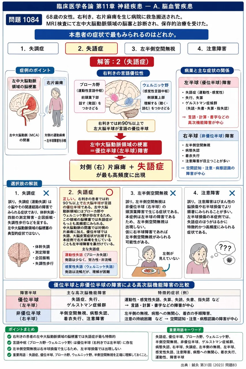 鍼灸 第31回(2023) 問題83|「68歳の女性。右利き。右片麻痺を生じ病院に救急搬送された。MRI検査にて左中大脳動脈領域の脳塞と診断され、保存的治療を受けた。」本患者の症状で最もみられるのはどれか。 解説図