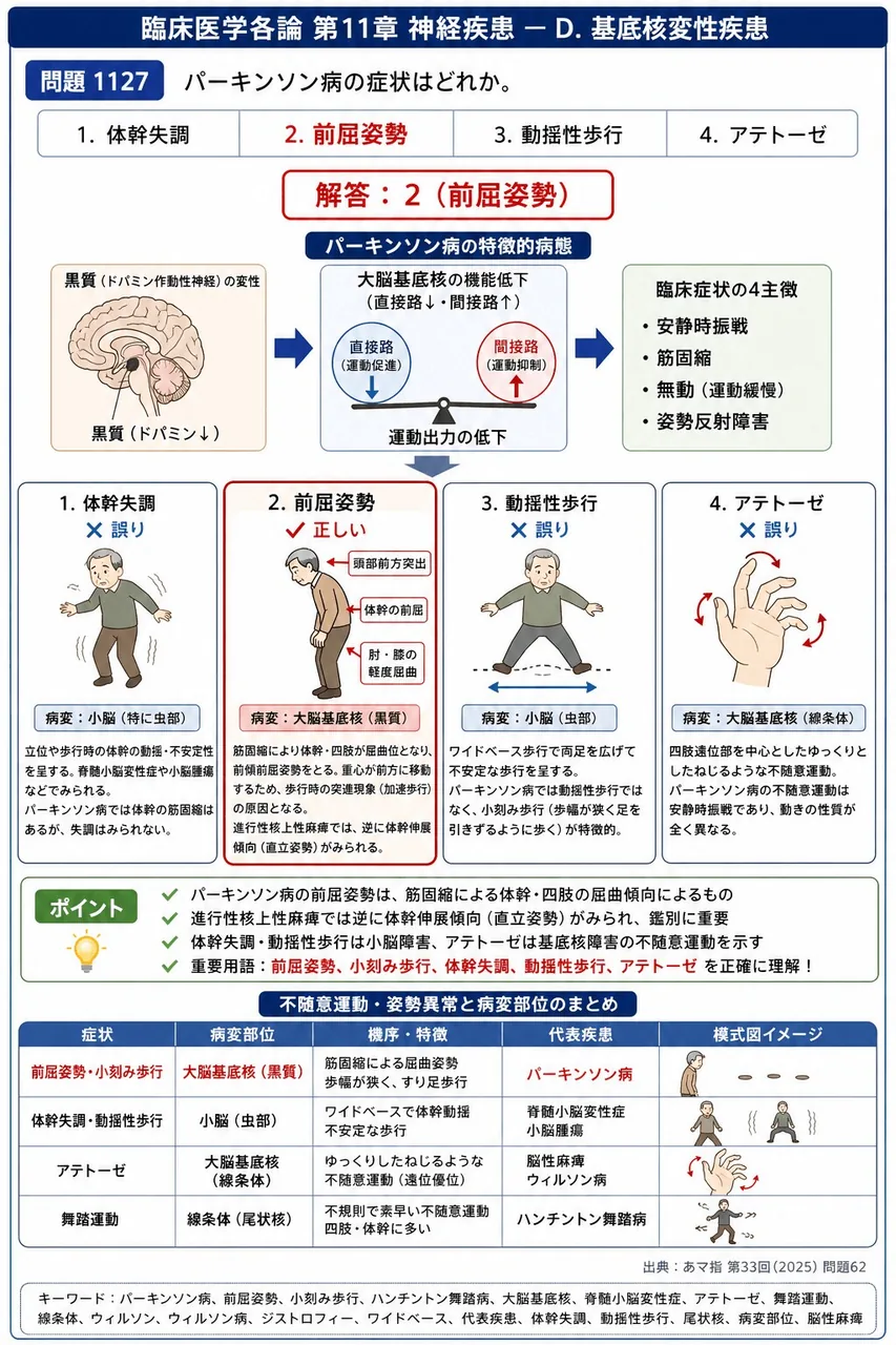 あマ指 第33回(2025) 問題62｜パーキンソン病の症状はどれか。 解説図