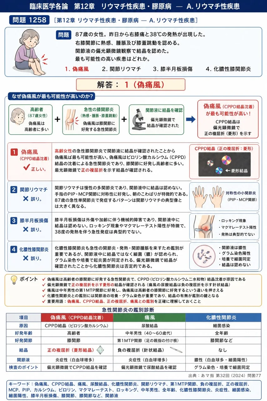 あマ指 第32回(2024) 問題77|次の文で示す症例について、問いに答えよ。「87歳の女性。昨日から右膝痛と38℃の発熱が出現した。右膝関節に熱感、腫脹及び膝蓋跳動を認める。関節液の偏光顕微鏡観察で結晶を認めた。」最も可能性の高い疾患はどれか。 解説図