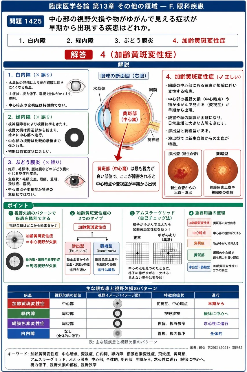 鍼灸 第29回(2021) 問題62|中心部の視野欠損や物がゆがんで見える症状が早期から出現する疾患はどれか。 解説図