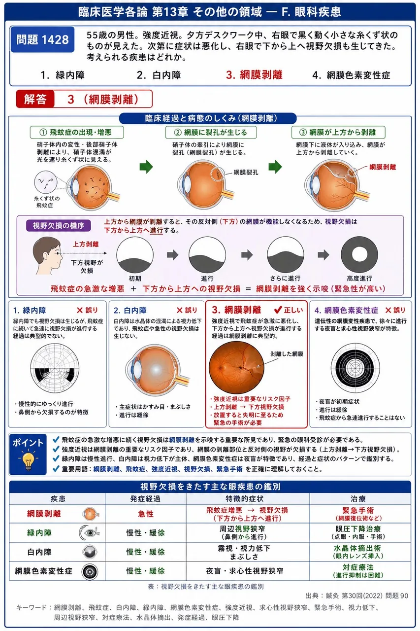 鍼灸 第30回(2022) 問題90|「55歳の男性。強度近視。夕方デスクワーク中、右眼で黒く動く小さな糸くず状のものが見えた。」次第に症状は悪化し、右眼で下から上へ視野欠損も生じてきた。考えられる疾患はどれか。 解説図
